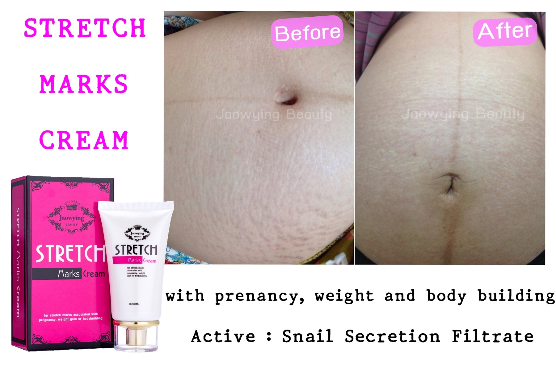 Stretch Mark Remover Cream - Safe Stretch Marks Removal Cream with Snail Secretion Filtrate, Tightens Loose Skin & Heals Stretch Marks Caused by Pregnancy, Weight Gain, Bodybuilding - NET 2.82 Oz. (80 G.)