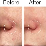 The INKEY List Hydrocolloid Pimple Patches 22– Invisible Spot Cover view 7