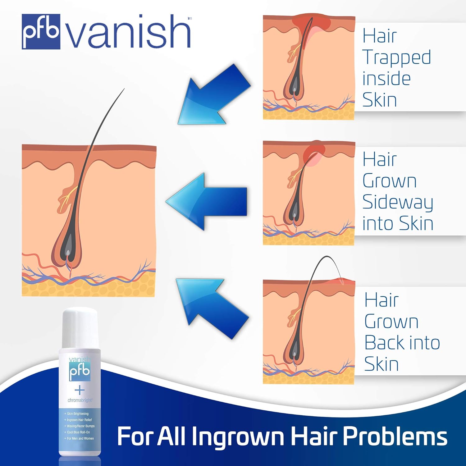 Pfb Vanish Chromabright For Ingrown Hair And Skin Lightening In