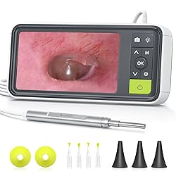 Anykit Digital Otoscope with Gyroscope, 4.5 Inches