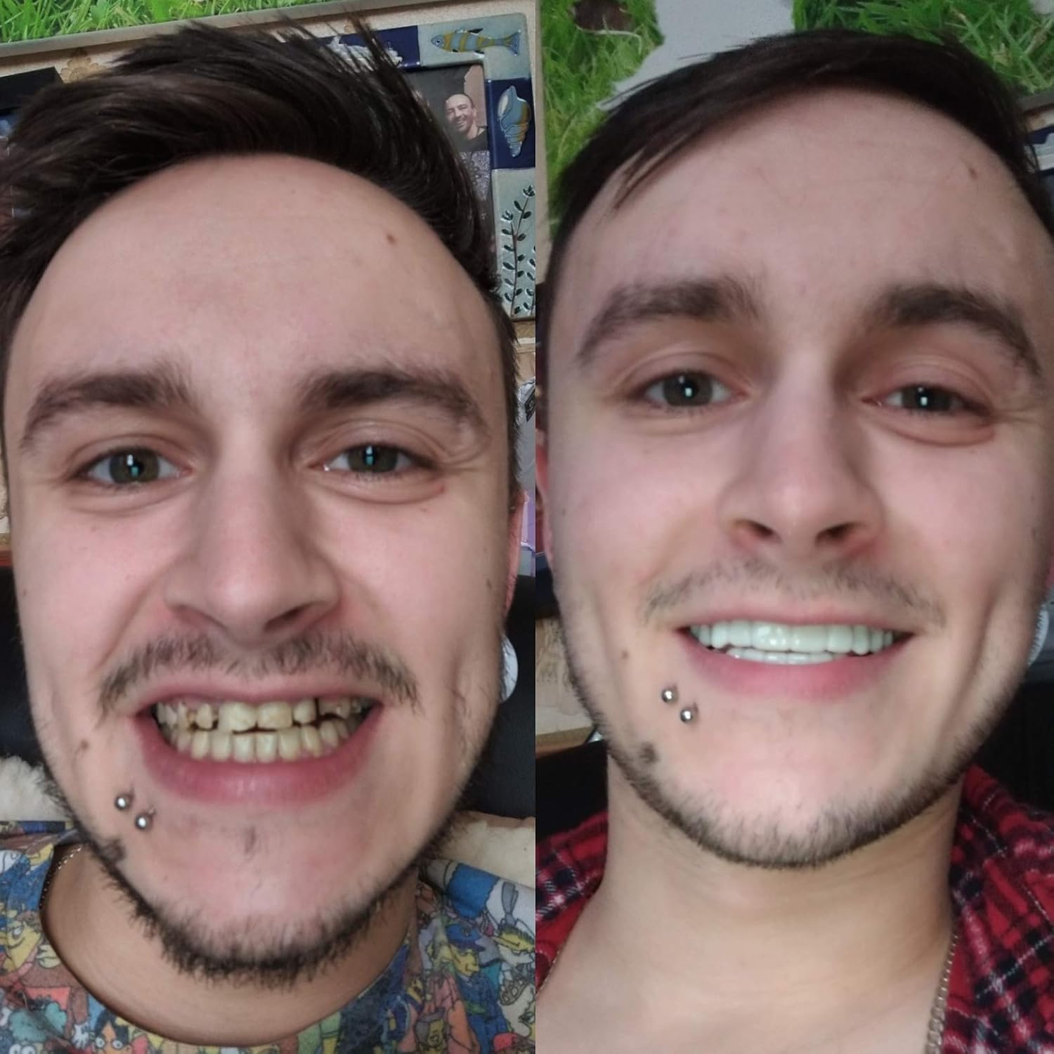 Clip On Veneers Custom Made To Your Dental Profile Using Our Home Impression System In A1 Shade Amazon Co Uk Health Personal Care