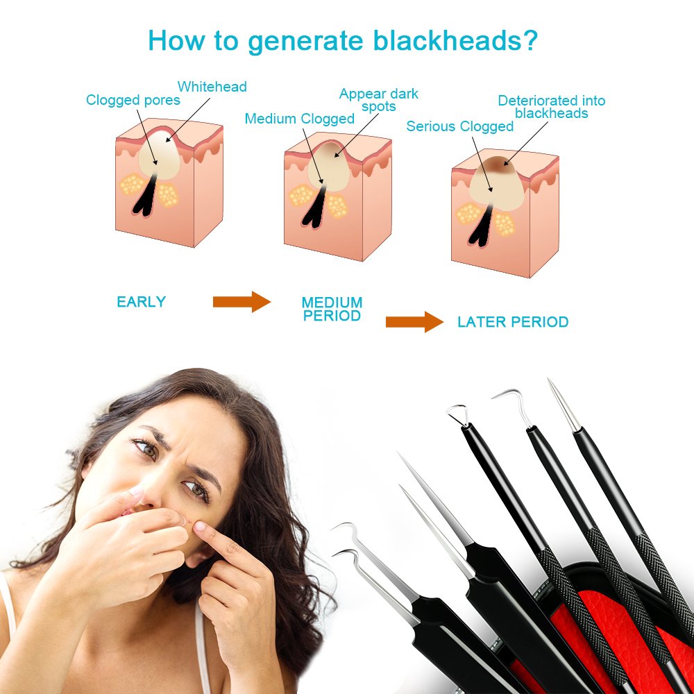 Review for Blackhead Remover Tool,Sedremm 5 in 1 Acne Pimple Extractor