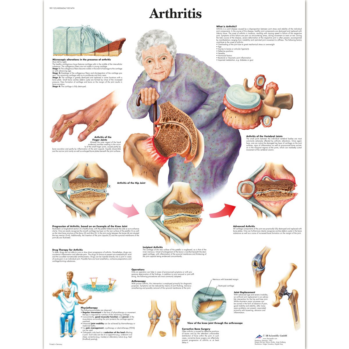 3B Scientific Human Anatomy - Arthritis Chart, Laminated Version