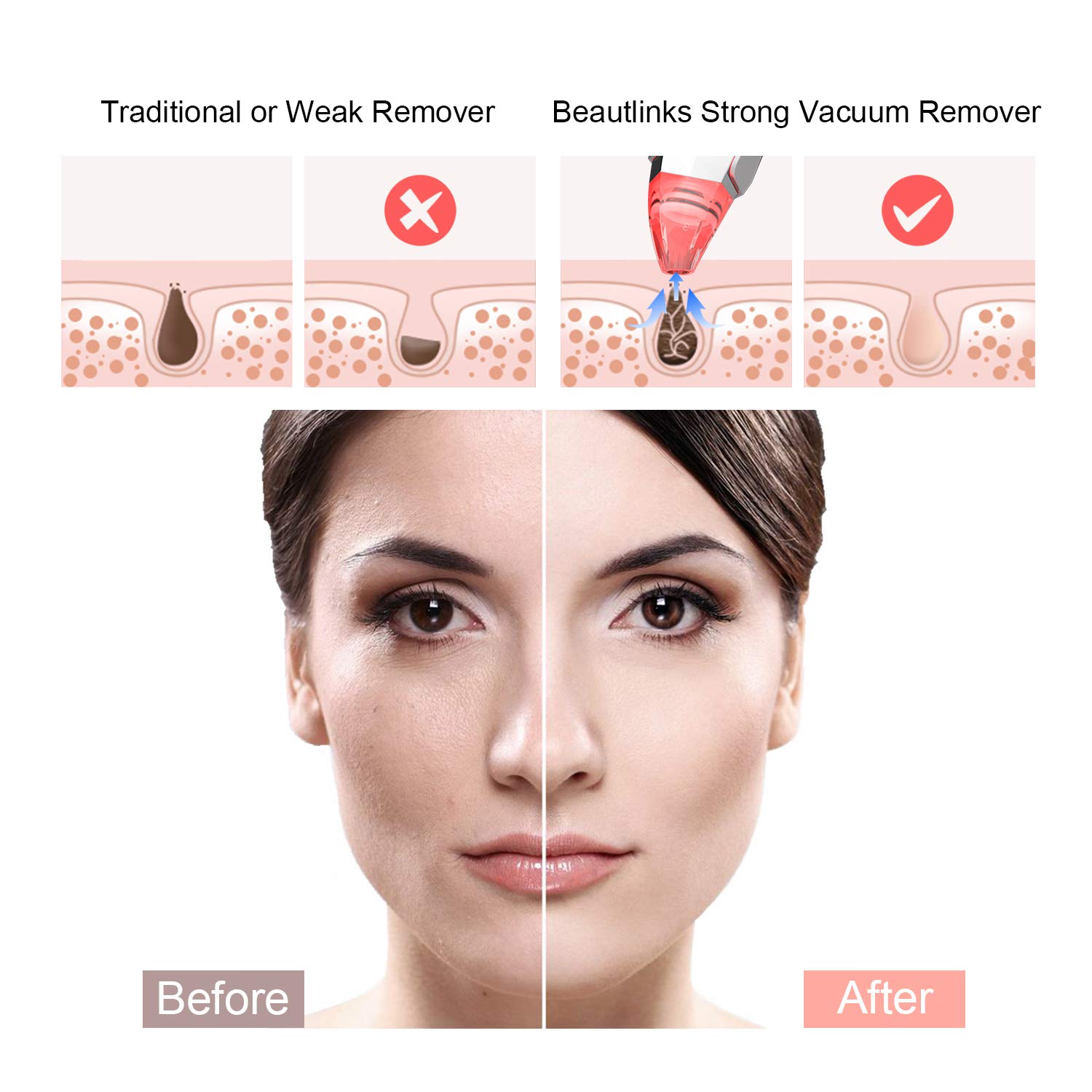 Aspirateur Point Noirs Extracteur Rechargeable, Beautlinks Facial Pores Nettoyant Point Noir, Retirer les Blackhead Visage avec 3 LED Lumières de Beauté, 5 Niveaux et 5 Têtes d\'Aspiration