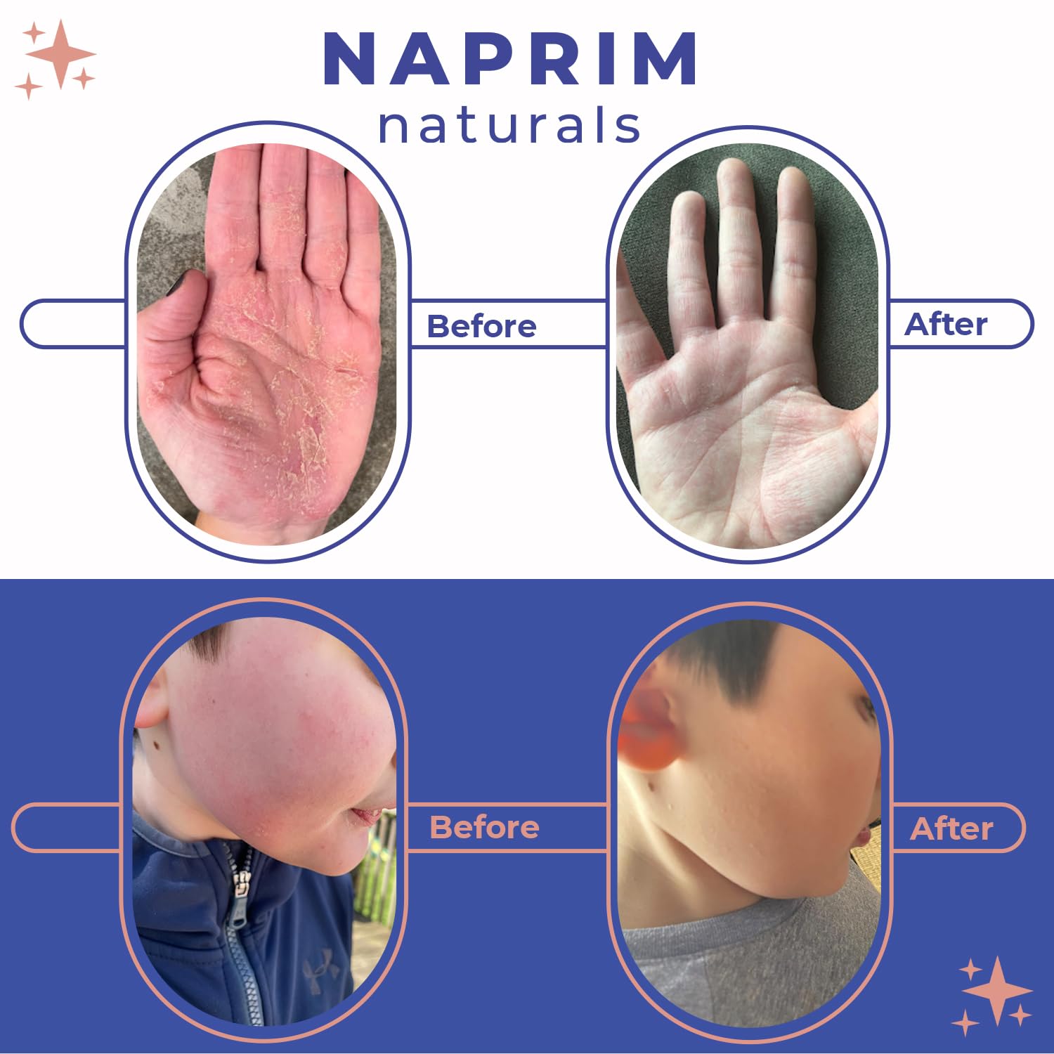 NAPRIM Naturals Nourishing Powder - Hypoallergenic, Talc-Free Skin Relief for Eczema, Psoriasis, Dermatitis, Acne with Colloidal Oatmeal - Reduce Redness, Irritation & Rashes, Safe for Babies, 0.71 oz