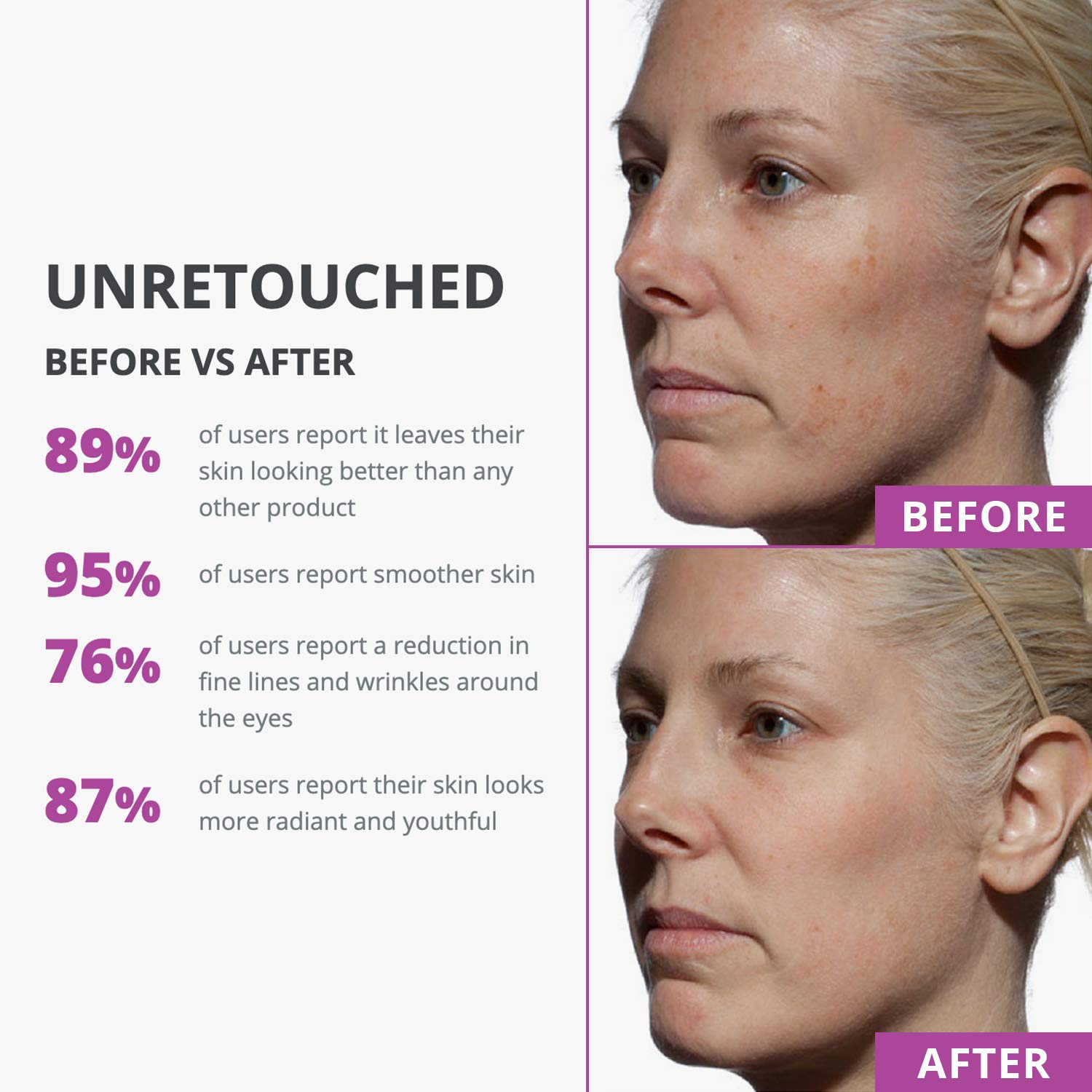 tria skin rejuvenating laser