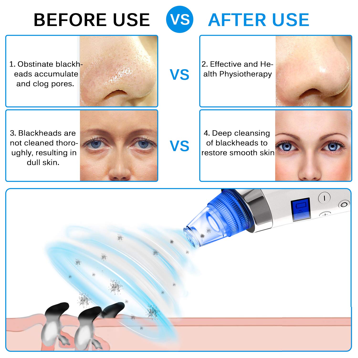 Blackhead Remover Pore Vacuum Comedo Blackhead Vacuum Suction Microdermabrasion Electric Acne Extractor Blackhead Cleaning Tool Exfoliating Machine with LED Display for Facial Skin Treatment: Beauty