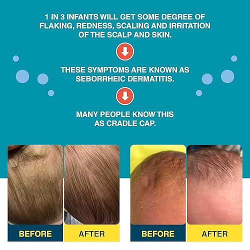 Happy Cappy Cradle Cap Medicated Shampoo and Body Wash with Beanie Brush  Baby Dandruff Shampoo, Helps Infant