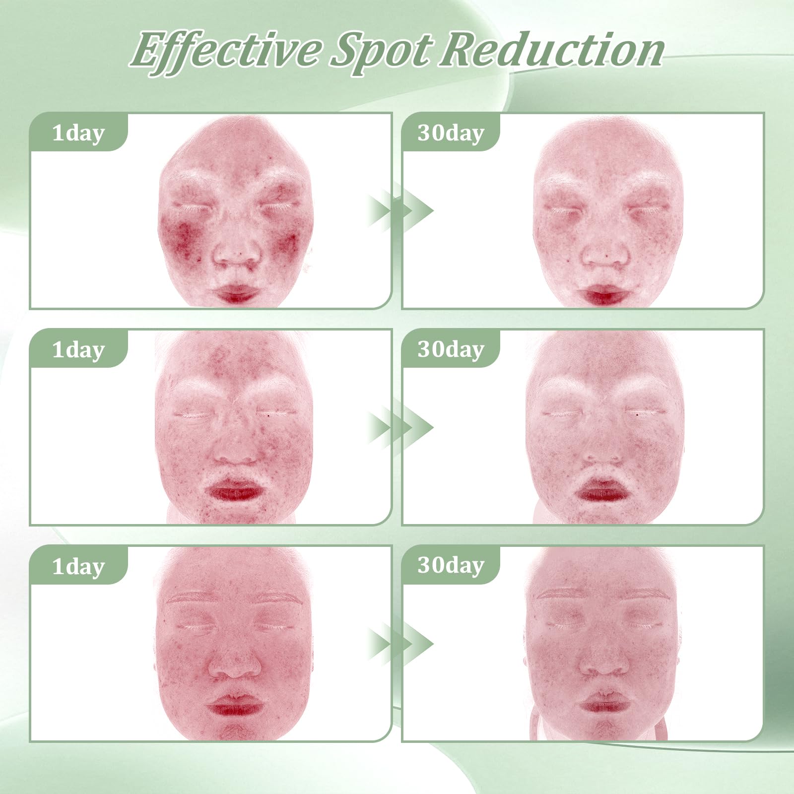 2% Salicylic Acid Acne Treatment Cream for Face Back/Butt/Body,Spot Treatment for Pimples,Face Blemishes,Blackheads,Oil Control,Ingredients are Natural,Suitable for Teenagers/Women/Men（30g）