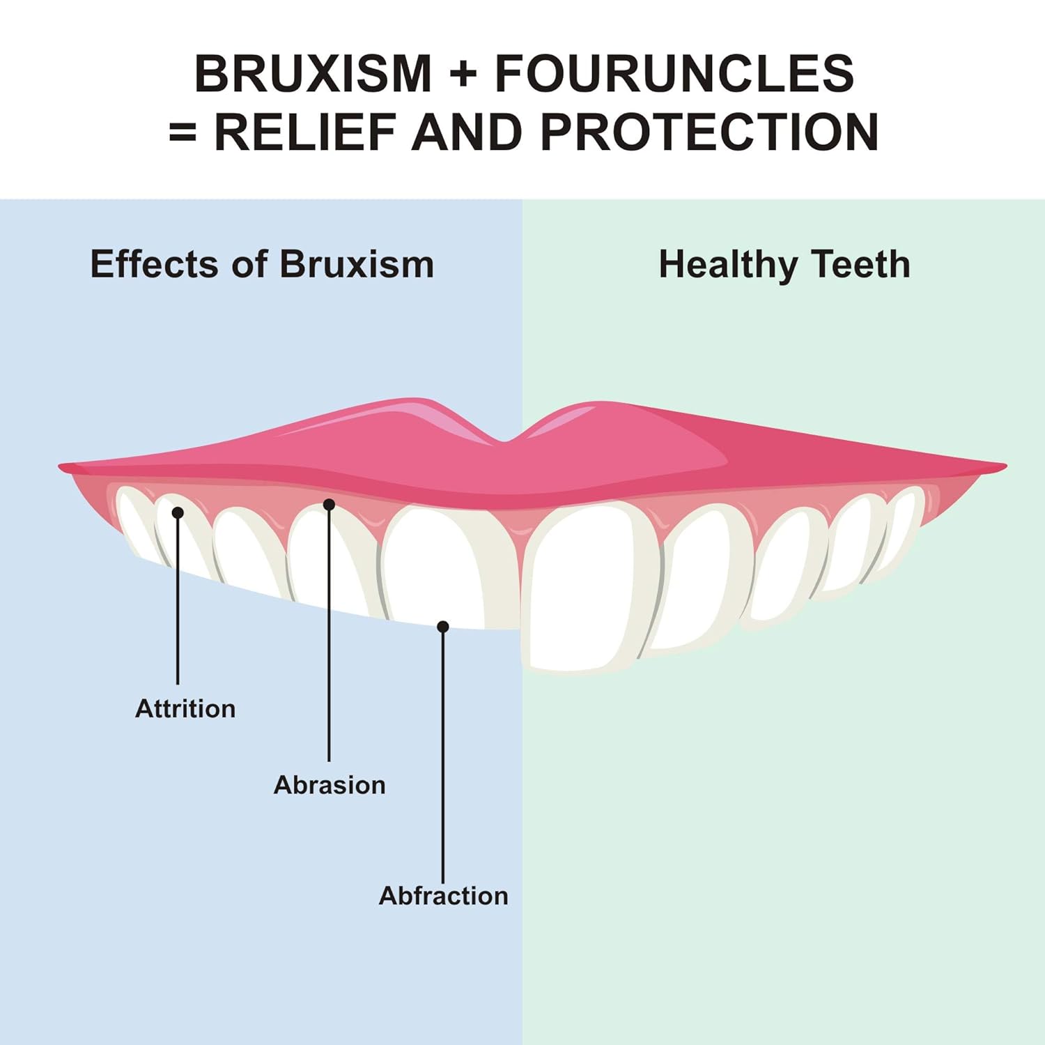 Mouth Guard for Teeth Grinding Clenching Bruxism-6 BPA FREE New Upgraded FOUR UNCLES Anti Dental Night Guard for sleep Moldable, Including 4 Regular and 2 Heavy Duty Guard & Travel Retainer Case : Beauty