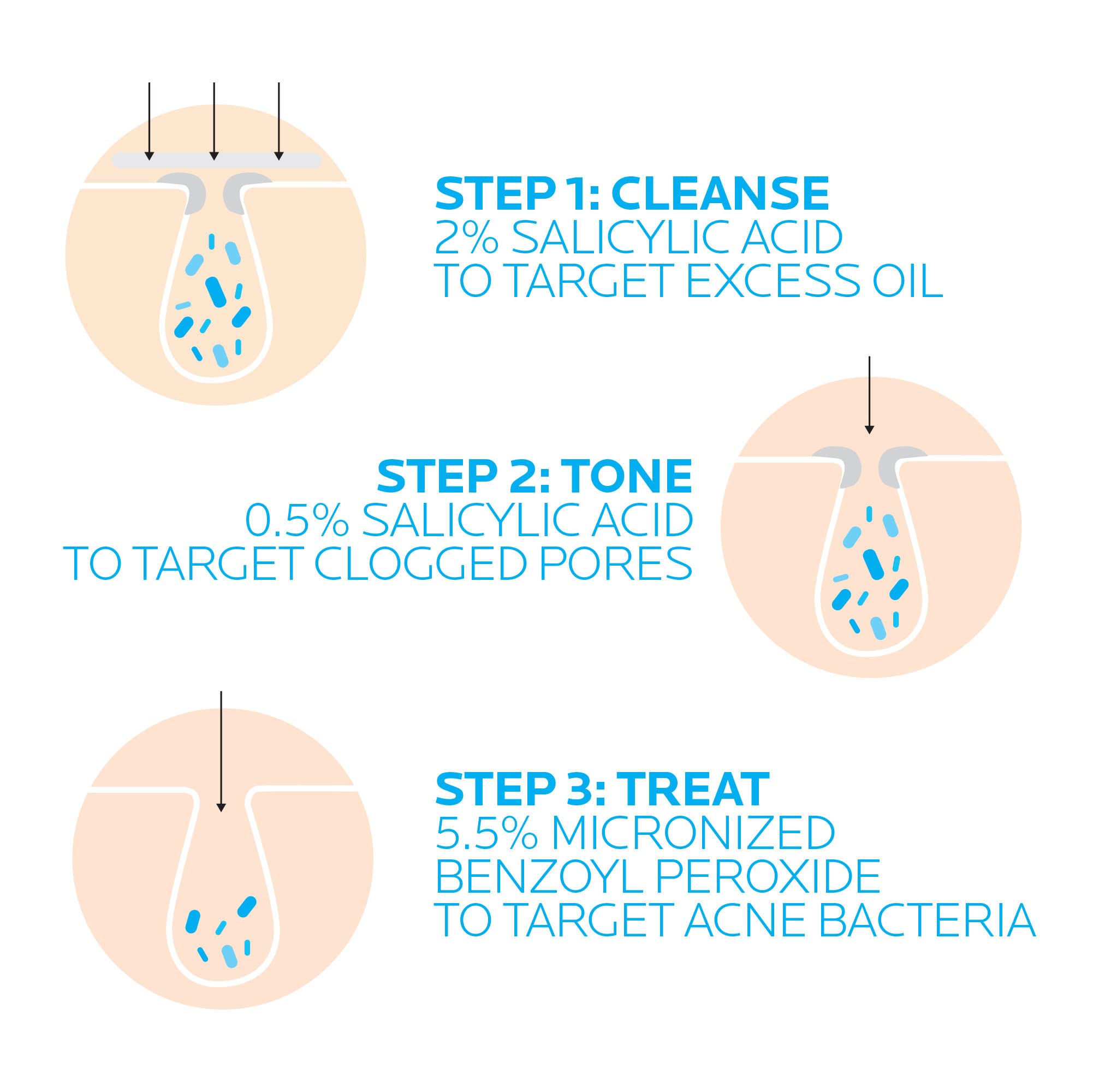 La Roche-Posay Effaclar Dermatological 3 Step Acne Treatment System, Salicylic Acid Acne Cleanser, Pore Refining Toner, and Benzoyl Peroxide Spot Treatment for Sensitive Skin