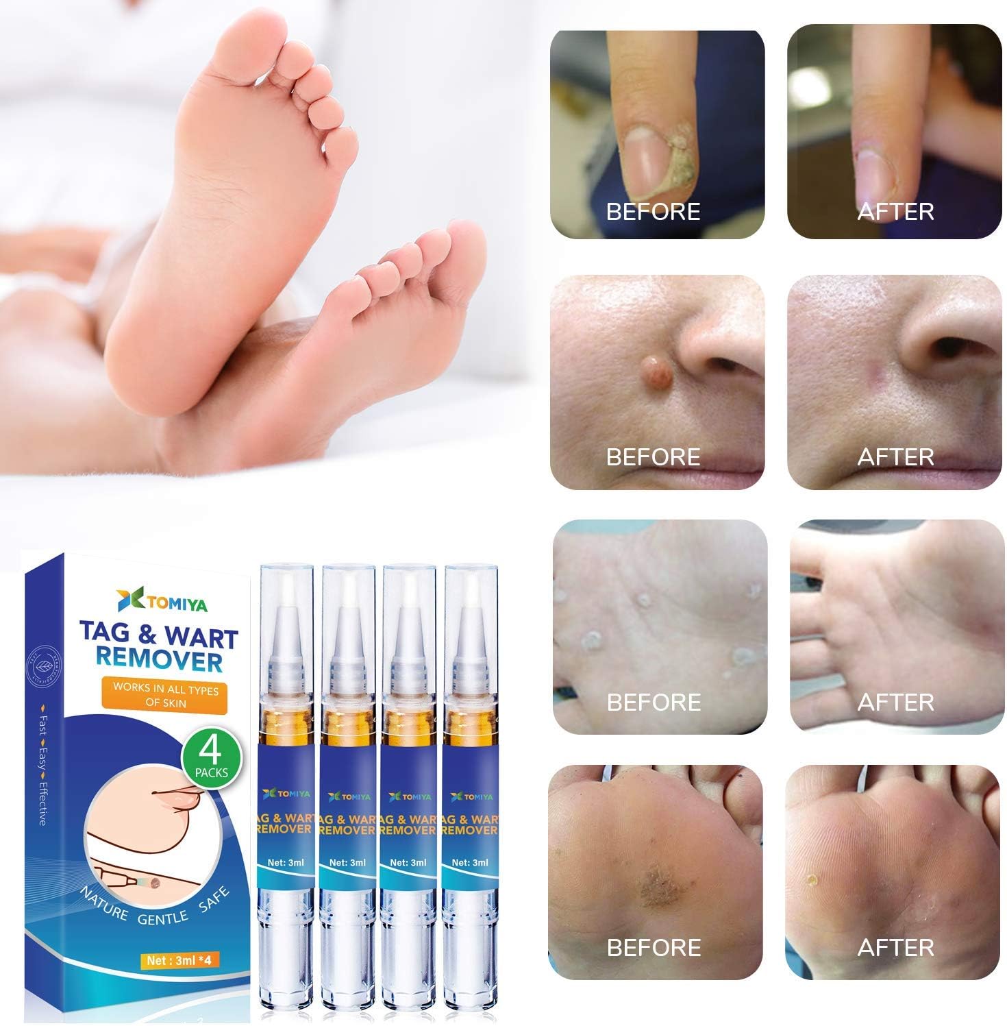 Tomiya Skin Tag Remover - Wart Remover - Quickly Remove Common And Plantar Warts - Corns - Callus -Skin Tag Removal(4 Packs) (Blue): Health & Personal Care
