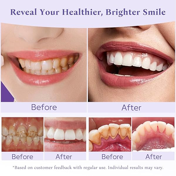 TEETH WHITENING POWDER, REMINERALIZING HYDROXYAPATITE TOOTH POWDER WITH NIACINAMIDE,R5X PURPLE COLOR CORRECTOR FOR INSTANT BRIGHTENING, ENAMEL REPAIR & LONG-LASTING NATURAL WHITE-30G
