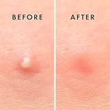 Rael Pimple Patches Miracle Overnight Spot Cover 3 Sizes 104 Count view 7