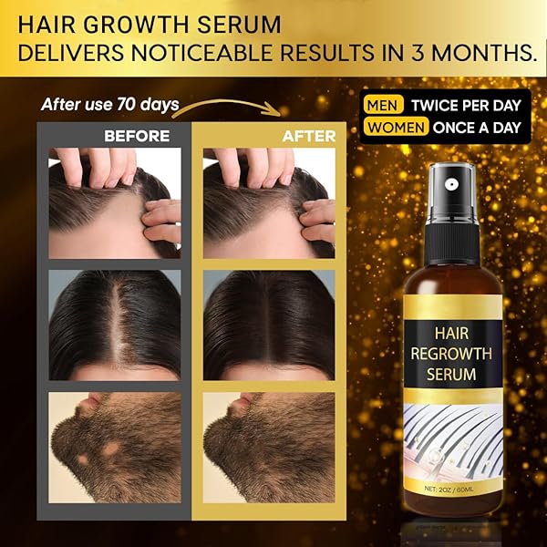 HAIR GROWTH OIL SPRAY: HAIR GROWTH SERUM SPRAY WITH ROSEMARY BIOTIN FOR HAIR LOSS AND THINNING-HAIR REGROWTH THICKENING FOR WOMEN MEN 2 FL OZ