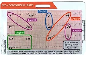 SUWIAKLALL ECG Pocket Card,Waterproof ECG Reference Card Pocket-Sized EKG Interpretation Guide Ruler for Nurses Medical Stude