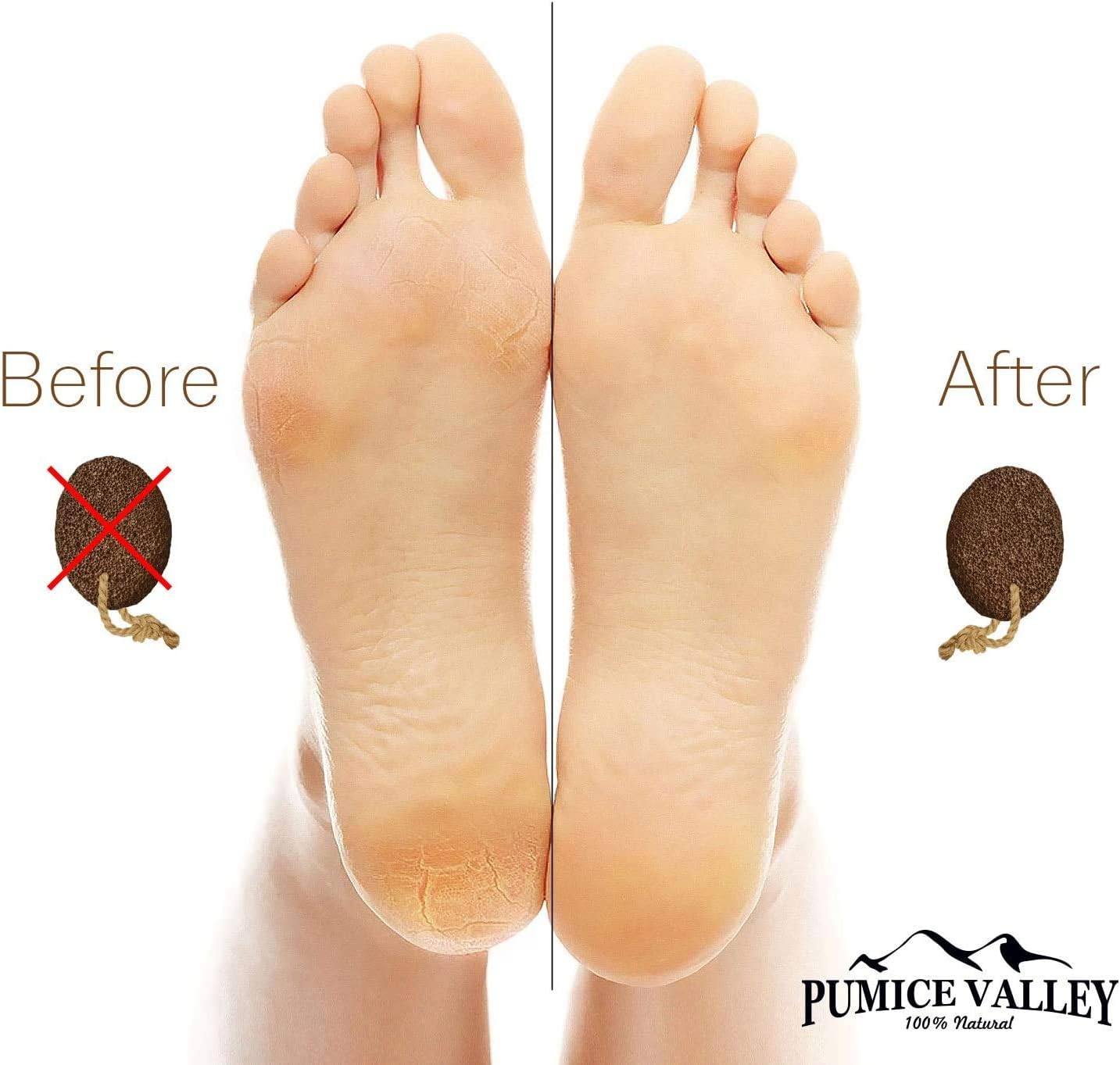 Pumice Stone for Feet - Natural Lava Foot Stone with New Eco-Friendly Holder - Callus Warts Corn Removal - Pedicure Exfoliator for Dry Dead Skin, Heels, Elbows, Hands - Healthy Foot Care Scrubber: Health & Personal Care
