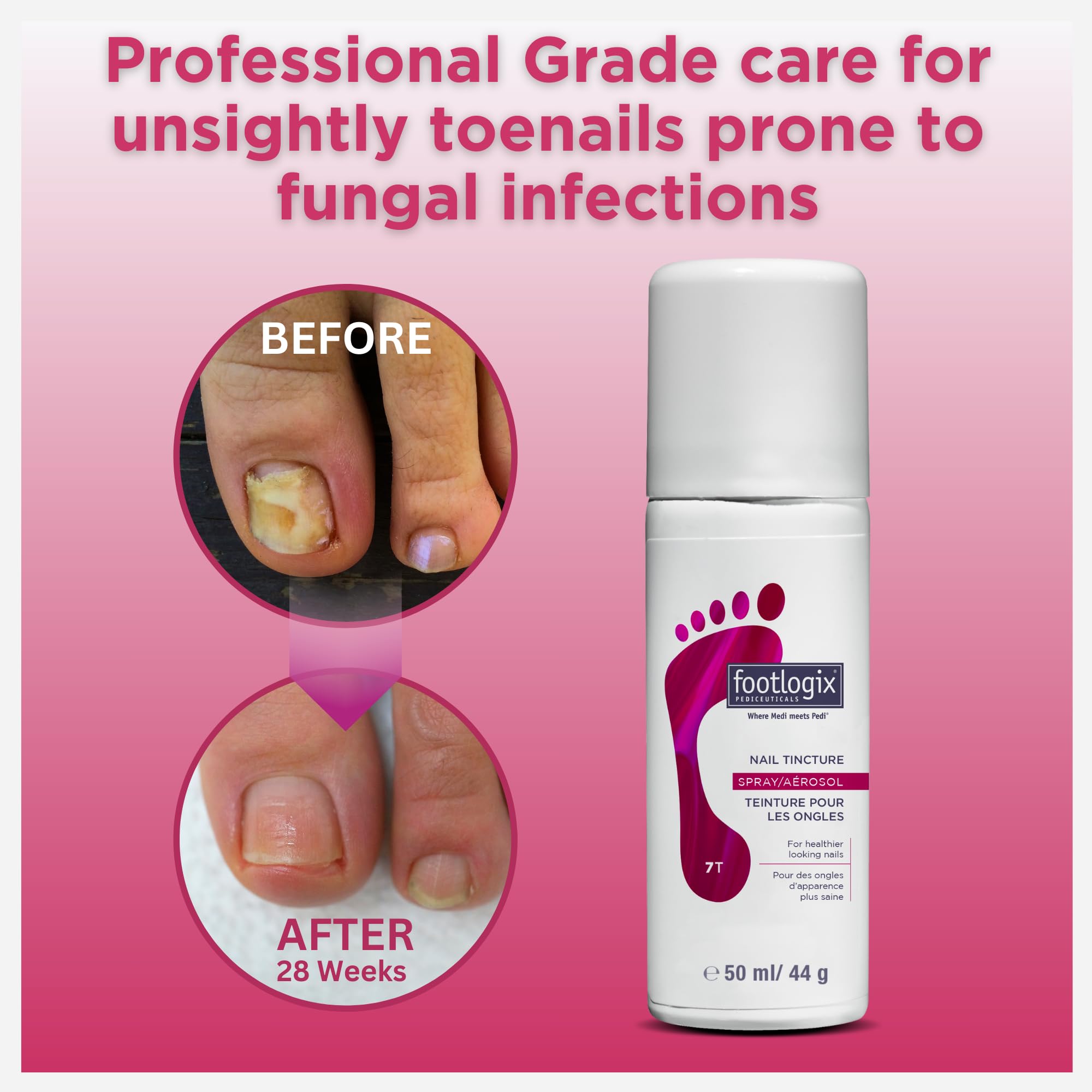 FOOTLOGIX Anti-Fungal Toe Tincture Spray, 1.7 Fl Oz (Pack of 1)