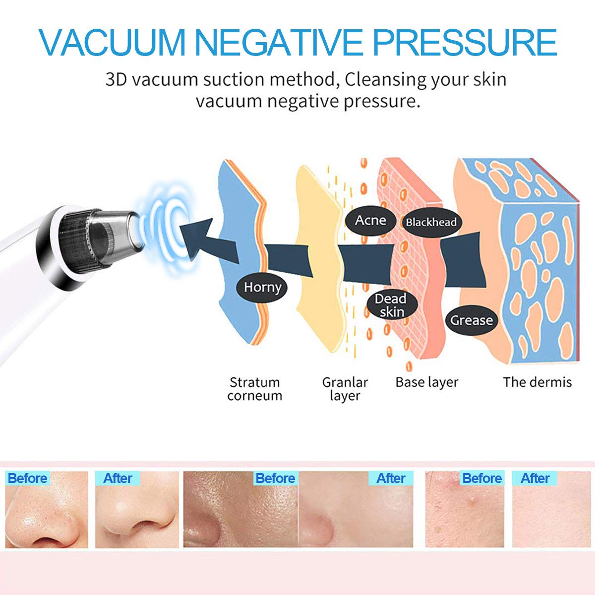Blackhead Remover Vacuum - Ralthy Electric Blackhead Removal Tools Pore Cleaner Extractor Fast USB Rechargeable Pore Vacuum Including 4 Patterns and 5 Suction Probes for Women and Men [Hot Compress]: Beauty