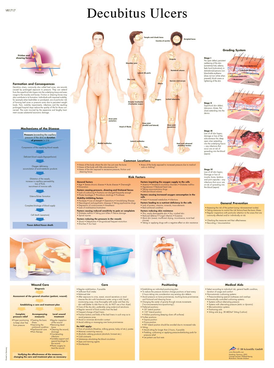 3B Scientific Human Anatomy - Decubitus Ulcers Chart, Laminated Version