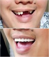 Instant Smile Comfort Fit Flex Cosmetic Upper Teeth Bright White Veneer view 5