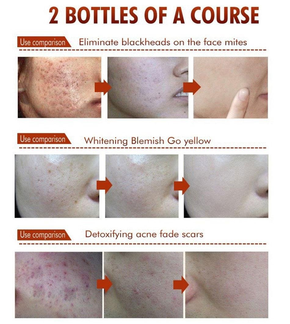 bioaqua acne cream reviews