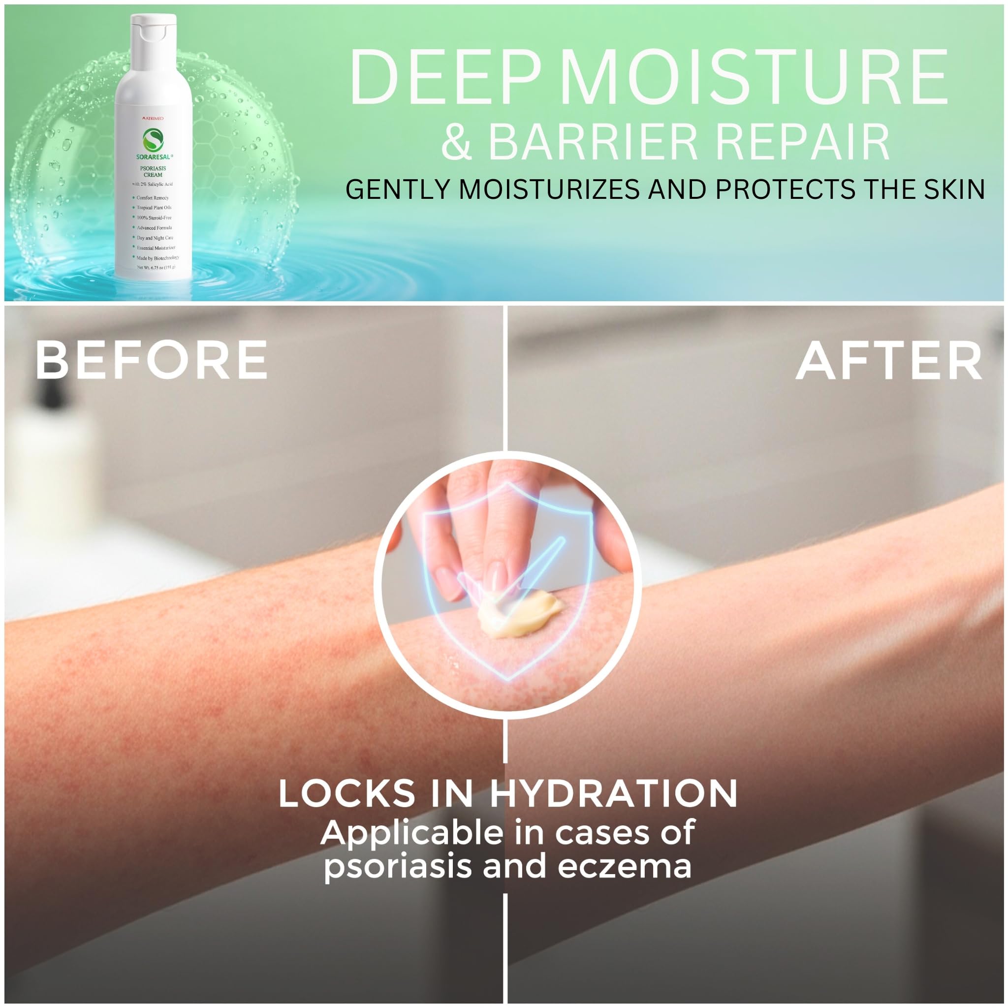 SORARESAL Psoriasis Cream - Comfort Remedy with Safflower Oil, Coconut Oil and Salicylic Acid – Eczema Cream for Itchy, Flaky Skin and Eczema Relief