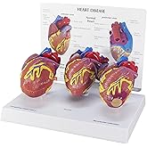 GPI Anatomicals 3-Piece Mini Heart Model Set, Normal and Diseased | 3-Piece Human Normal and Diseased Heart Model, Demonstrating Normal, Congestive Heart Failure, and Myocardial Infarction