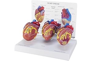 GPI Anatomicals - 3-Piece Mini Heart Model Set, Normal and Diseased Heart Models for Anatomy and Physiology Education, Anatomy Model for Doctor's Office and Classrooms, Medical Learning Resources