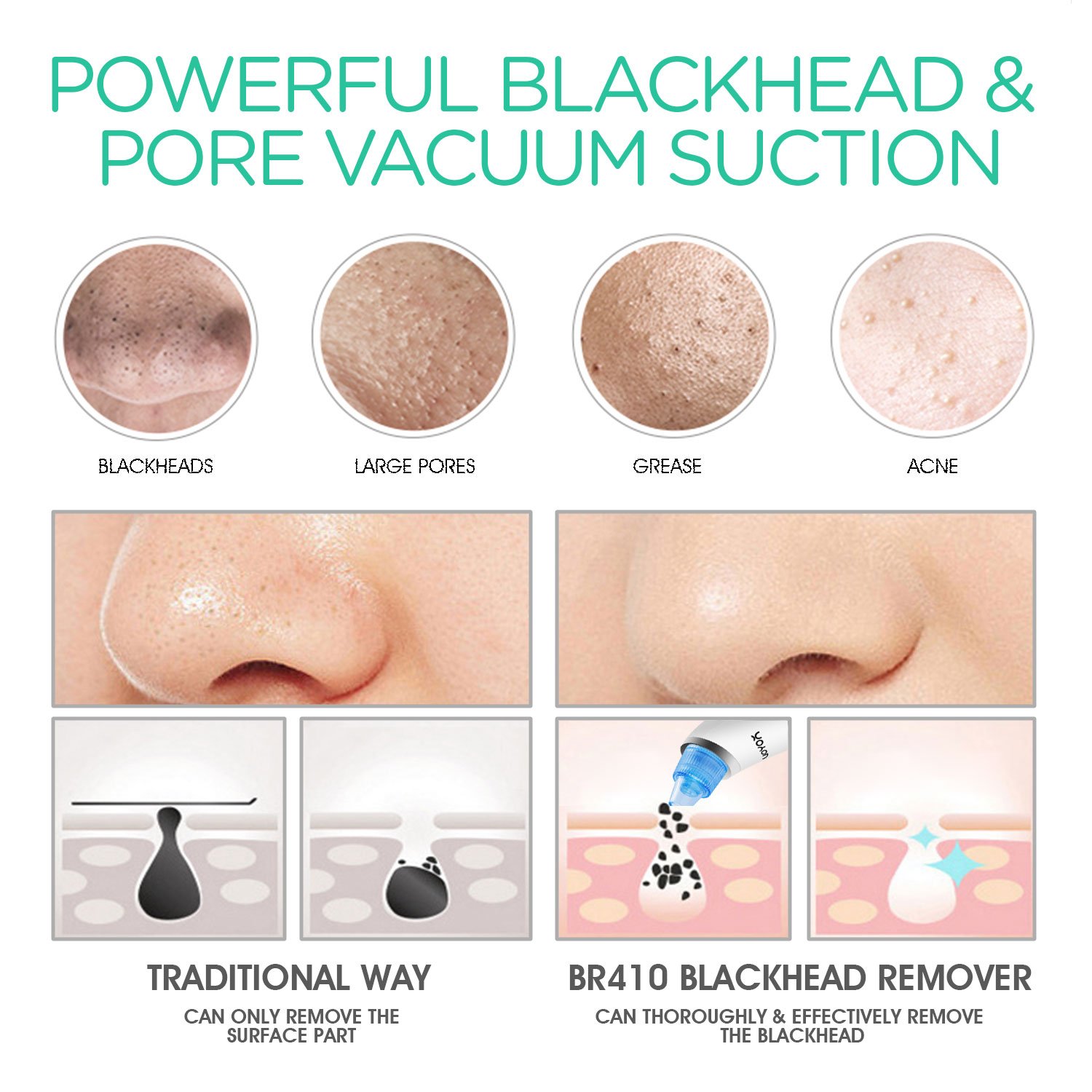 VOYOR Blackhead Remover Vacuum Suction Facial Pore Cleaner Electric Acne Comedone Extractor Kit with 6 Suction Head for Women and Men Black Heads Extraction BR410: Beauty
