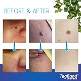 TagBand Original Skin Tag Remover Small/Medium Kit 2-4mm Face & Body view 2