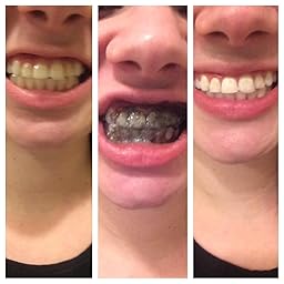 Baking Powder Teeth Whitening