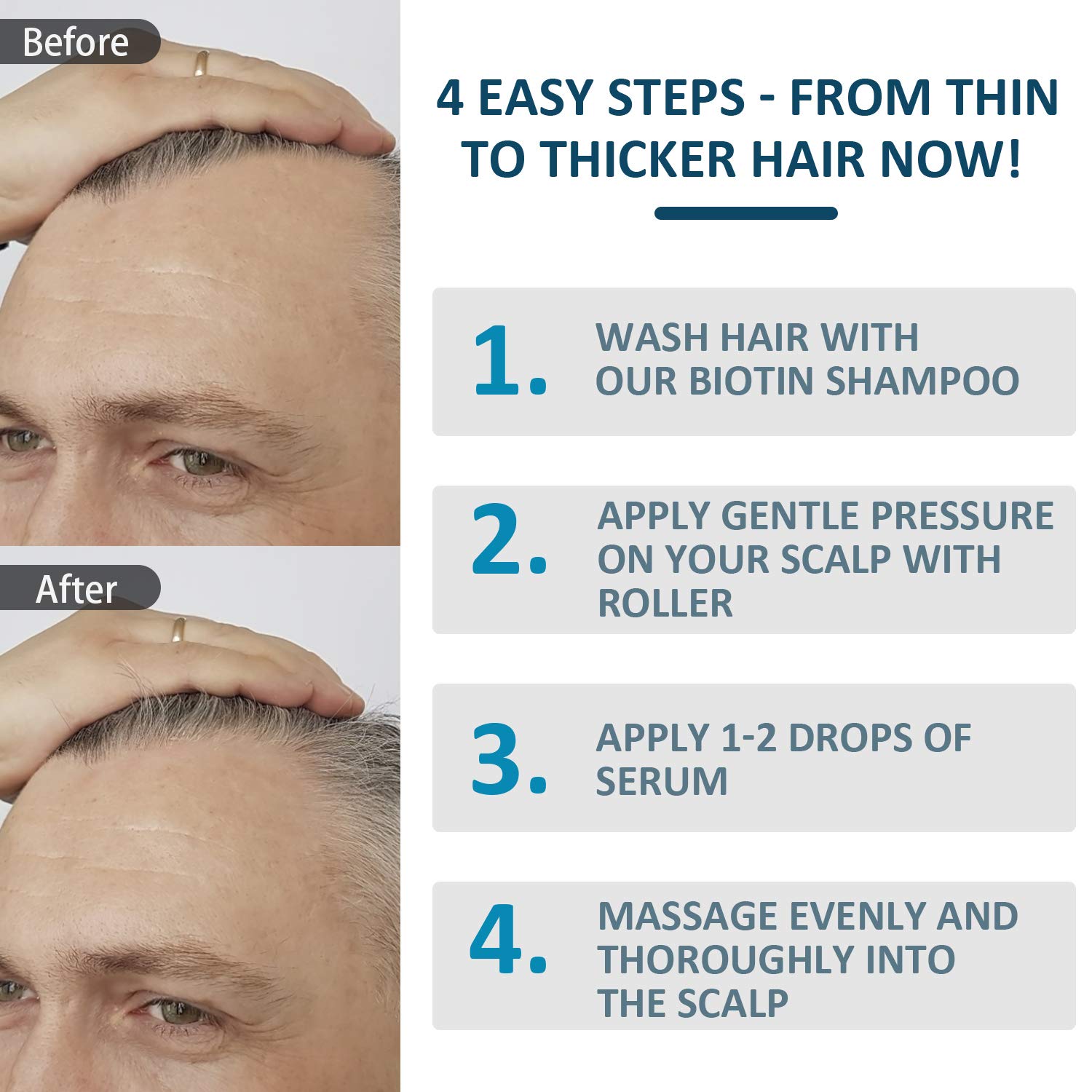 Derma Roller for Hair Growth, Biotin Hair Growth Serum + Scalp Hair Regrowth Shampoo for Men and Women, Best Hair Loss Treatment Product : Beauty