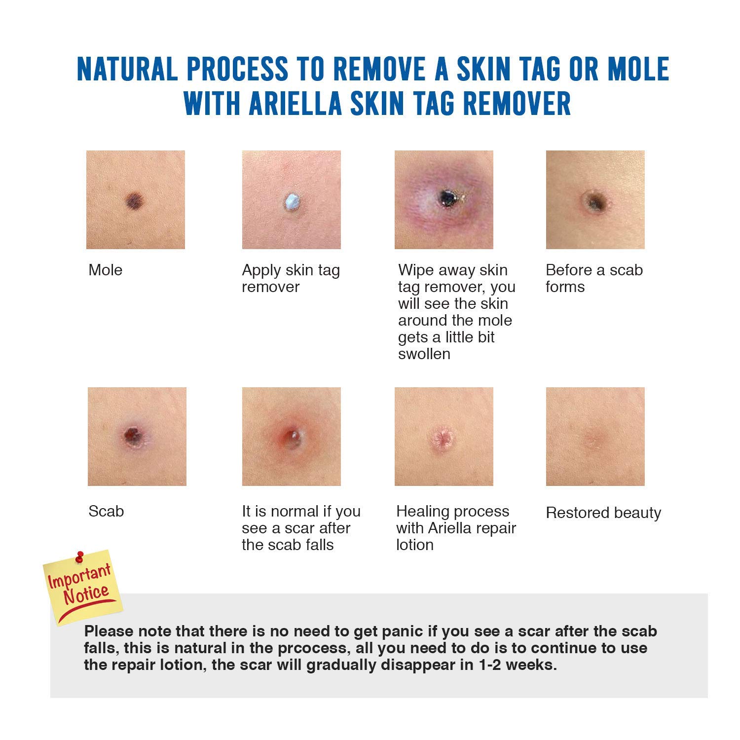 Ariella Mole and Skin Tag Remover and Repair Lotion Set, Remove Moles and Skin Tags : Beauty