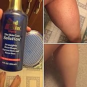 Amazon Com Tend Skin The Skin Care Solution For Unsightly Razor