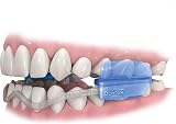 DenTek Comfort-Fit Dental Mouth Guards 2 Pack Lower Teeth Bruxism view 4