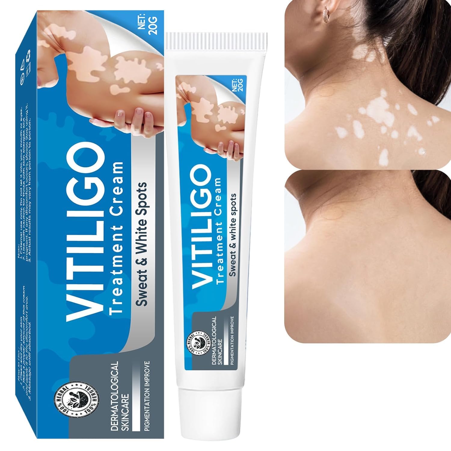 mua-vitiligo-treatment-vitiligo-cream-improve-skin-pigmentation
