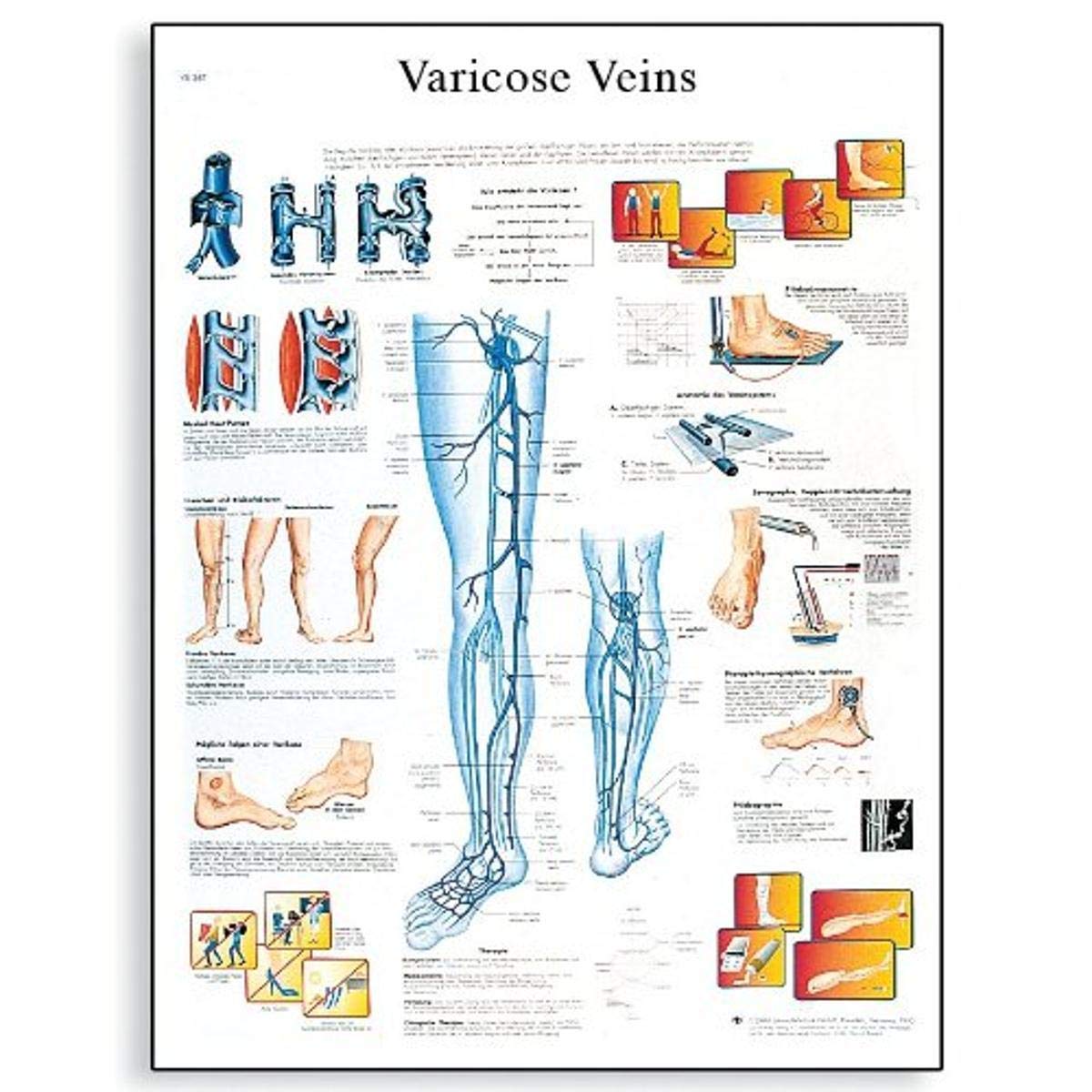 3B Scientific Human Anatomy - Varicose Veins Chart, Paper Version