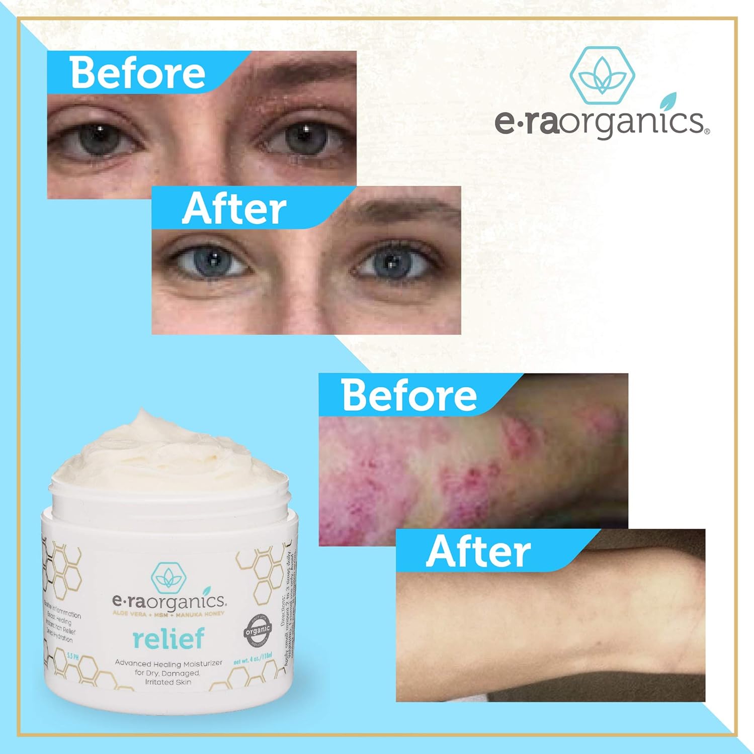 Era Organics Eczema, Psoriasis & Dermatitis Cream - Advanced 15-in-1 Non-Greasy Soothing Moisturizer with Aloe Vera, Manuka Honey, Hemp Oil & More. Face & Body Lotion for Dry Itchy Skin Care 4oz: Health & Personal Care