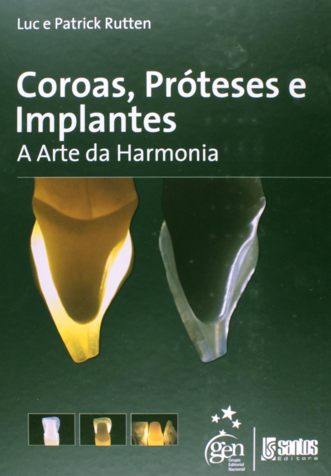 Coroas , Próteses E Implantes - A Arte Da Harmonia PDF Luc Rutten ...
