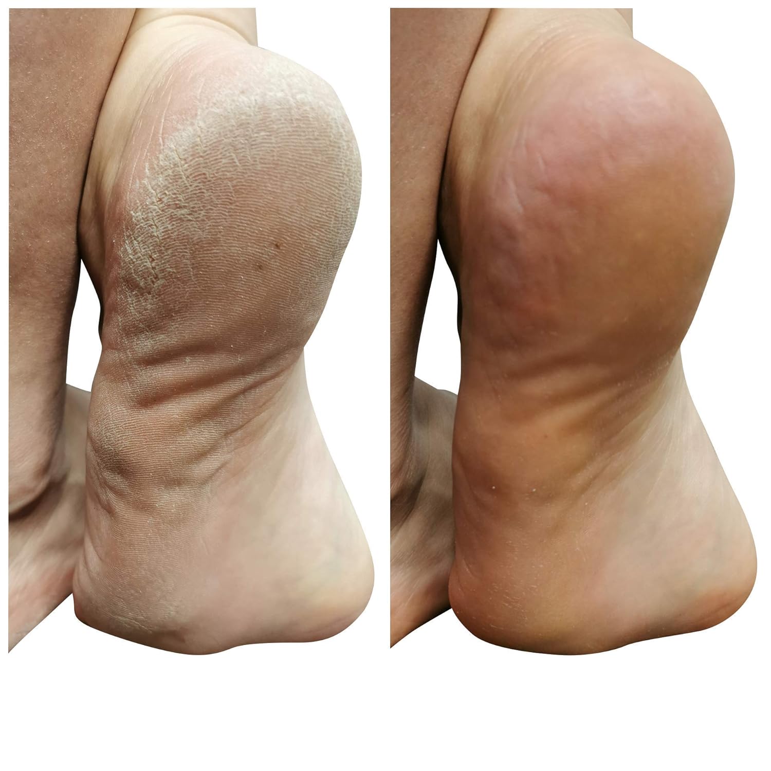 8oz Callus Remover gel for feet for a professional pedicure. Better results than, foot file, pumice stone, foot scrubber, foot buckets & callus shaver. Rid ugly callouses from feet in minutes!: Beauty