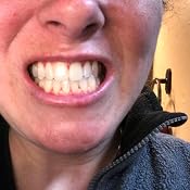 35 teeth whitening gel how long