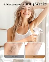 Haarlosy 3-in-1 IPL Laser Hair Removal Device for Home Use - Gold view 4