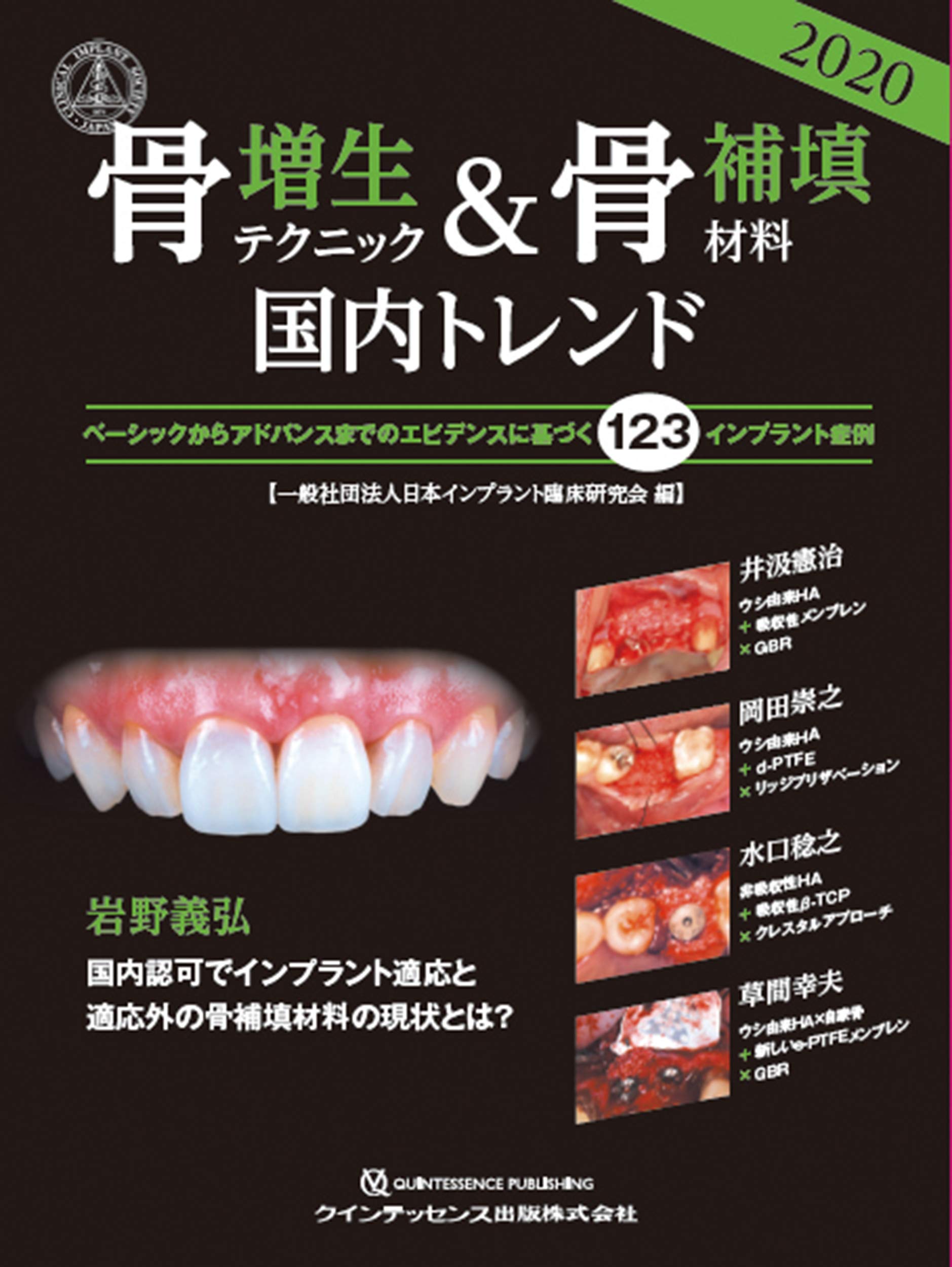 骨増生テクニック 骨補填材料2020国内トレンド 一般社団法人日本インプラント臨床研究会 本 通販 Amazon