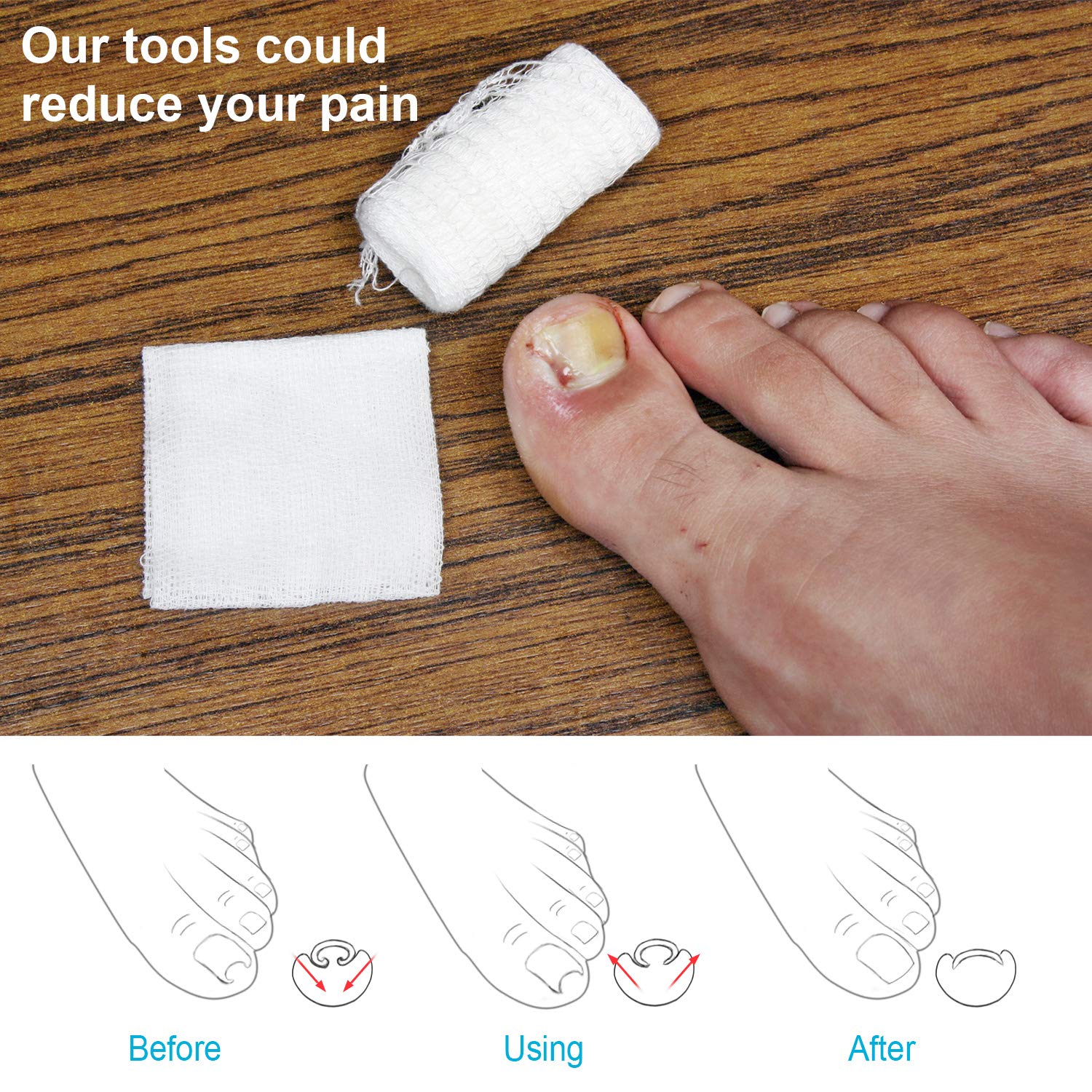 2 Pieces Ingrown Toenail Lifter Ingrown Toenail Tool Toe Clamp Stainless Steel Foot Care Tool for Paronychia (Gold): Beauty
