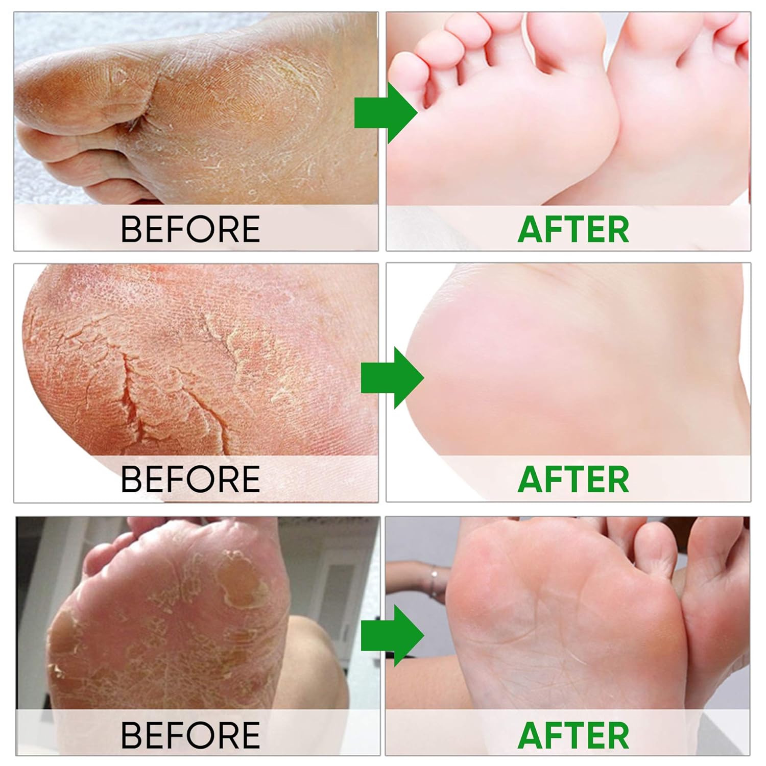 Exfoliating Foot Peel Mask for Smooth Soft Touch Feet - 2 Pairs per Box - Peeling away Calluses and Dead Skin Remover. Repair Rough Heels 2 packs - Baby Foot Gel Socks Booties - Natural Aloe Extract: Beauty
