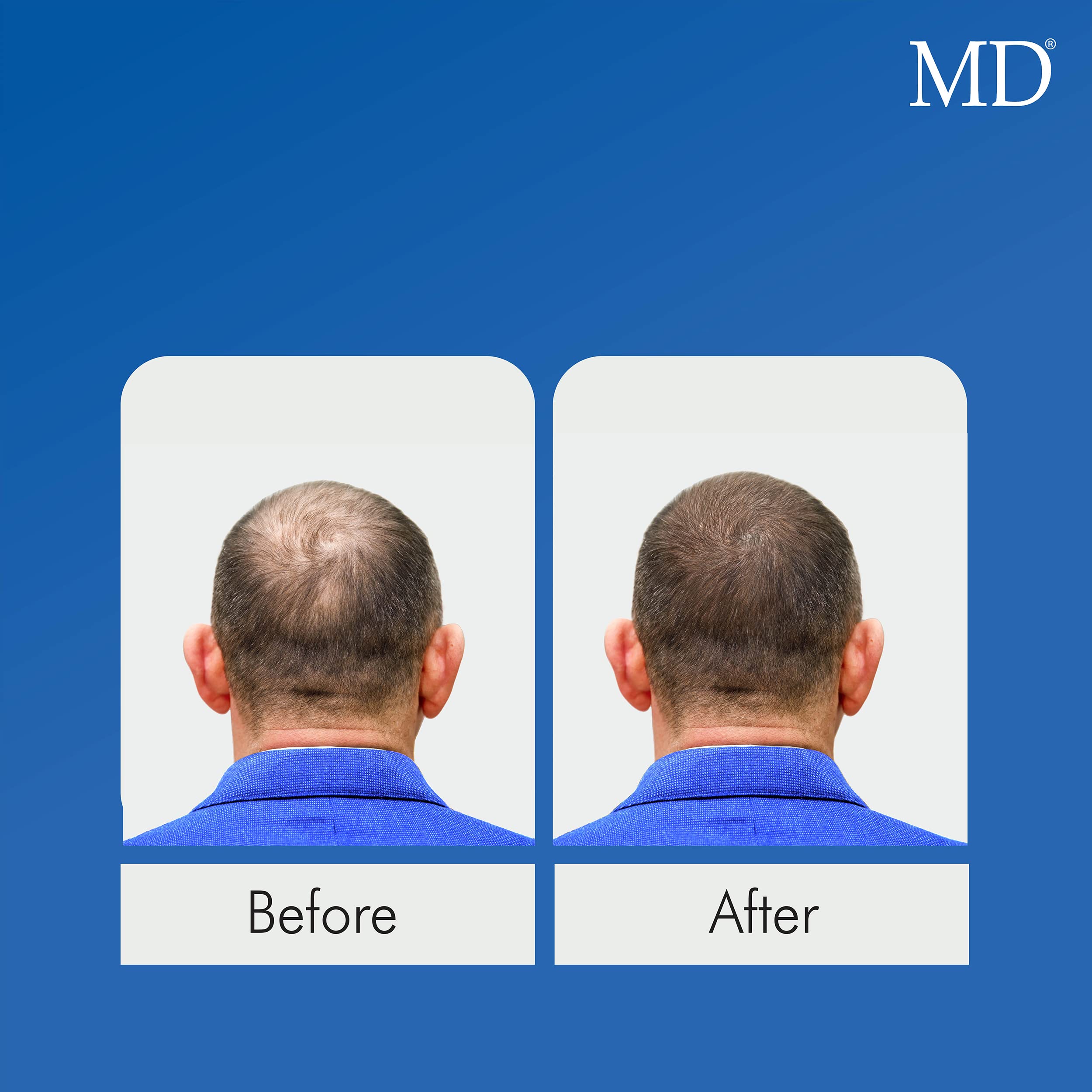 MD Nutri Hair Growth Supplement with Biotin (30 Capsules) | for Hair Loss, Minimizes Hair Shedding, Thinning, Breakage & Promotes Longer, Thicker Hair