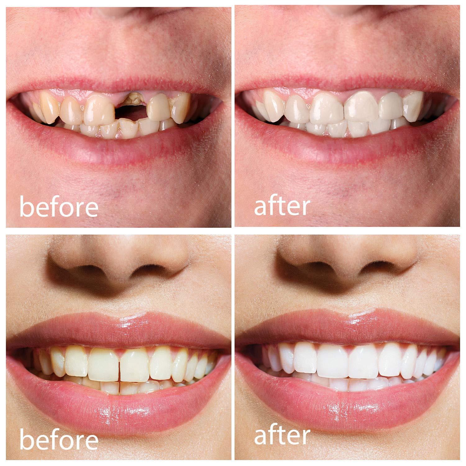 Temporary Tooth Repair Kit 3.53oz Thermal Adhesive Fitting Beads Temporary Tooth Replacements with Black Files and Small Scissor for Fixing Filling Missing Broken Tooth and Fake Teeth Veneers Supplies: Beauty