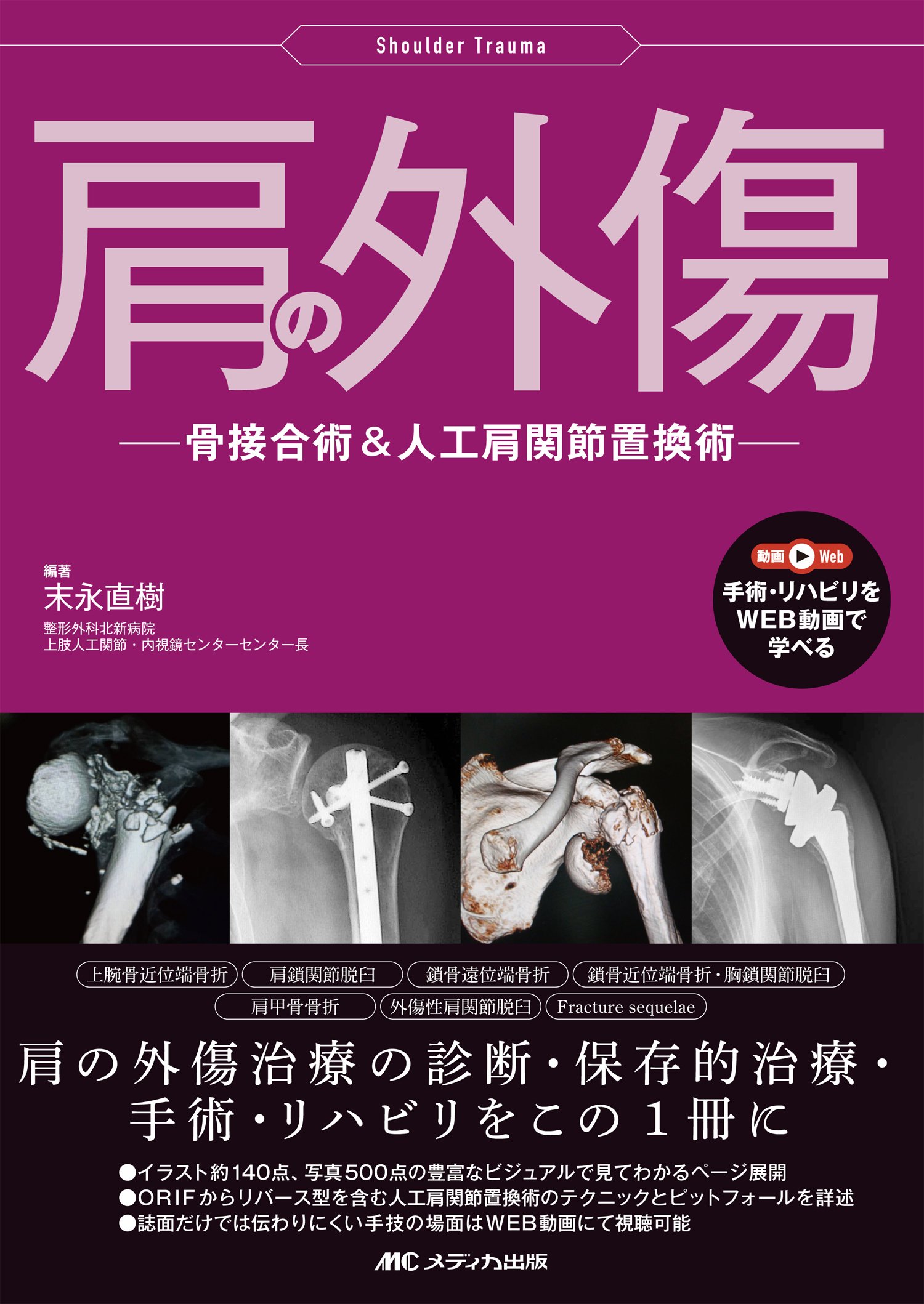 肩の外傷 骨接合術 人工肩関節置換術 末永 直樹 末永 直樹 本 通販 Amazon