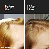Minimalist Hair Density Serum 18% Hair Growth Procapil Capixyl Redensyl Anagain view 2